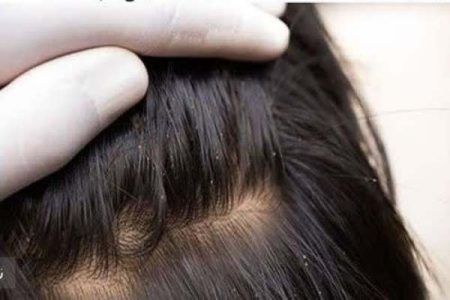 والدین از پنهان‌کاری درباره شپش خودداری کنند